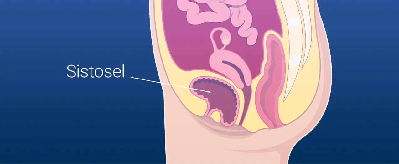 Sistosel (Mesane Sarkması - İdrar Kesesi Sarkması)