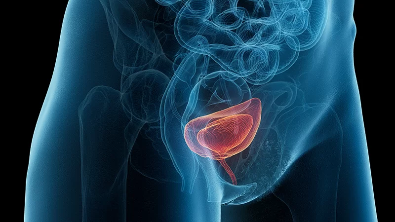 Aşırı Aktif Mesane