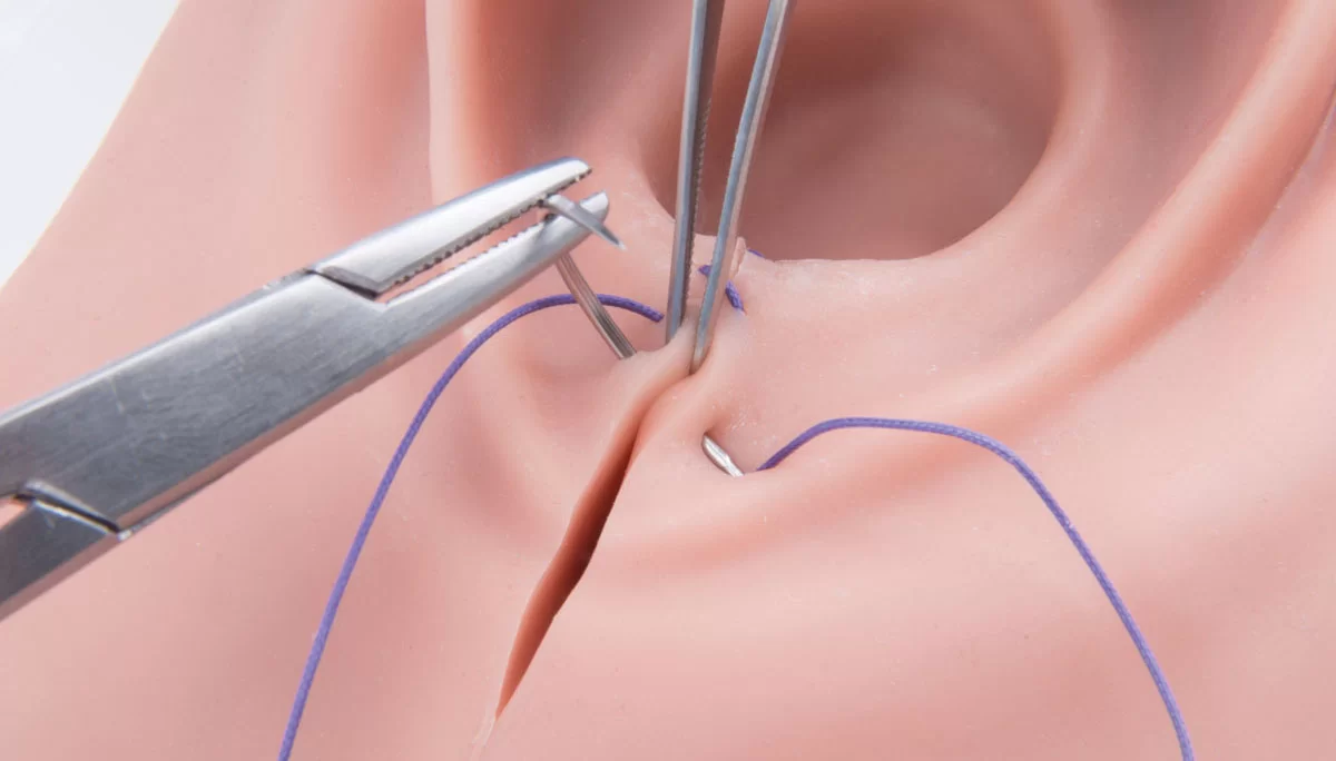 Epizyotomi - Perineoplasti